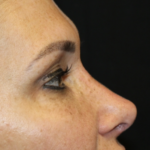 Rhinoplasty Before & After Patient #28642