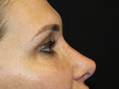 Rhinoplasty Before & After Patient #28642