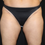Liposuction Before & After Patient #28568