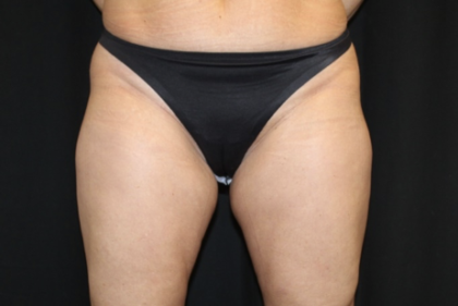 Liposuction Before & After Patient #28568