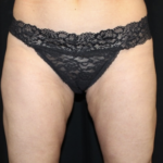 Liposuction Before & After Patient #28568