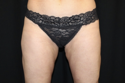 Liposuction Before & After Patient #28568