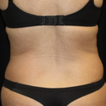 Liposuction Before & After Patient #28568