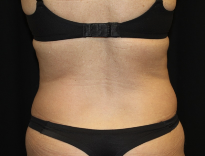 Liposuction Before & After Patient #28568