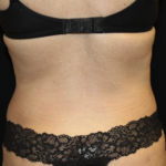 Liposuction Before & After Patient #28568