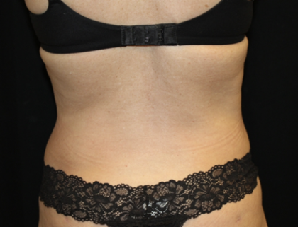 Liposuction Before & After Patient #28568