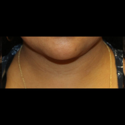 Liposuction Before & After Patient #28768
