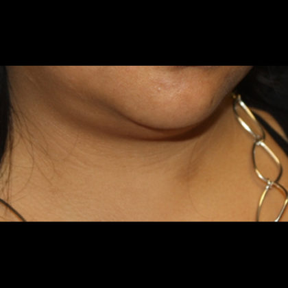 Liposuction Before & After Patient #28768