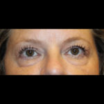 Blepharoplasty Before & After Patient #28788