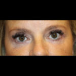 Blepharoplasty Before & After Patient #28788