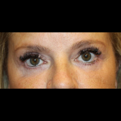 Blepharoplasty Before & After Patient #28788