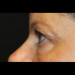 Blepharoplasty Before & After Patient #28788