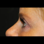 Blepharoplasty Before & After Patient #28788