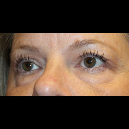 Blepharoplasty Before & After Patient #28788