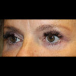 Blepharoplasty Before & After Patient #28788