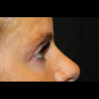 Blepharoplasty Before & After Patient #28788