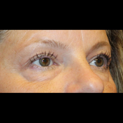 Blepharoplasty Before & After Patient #28788