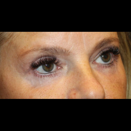 Blepharoplasty Before & After Patient #28788