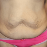 Tummy Tuck Before & After Patient #28581