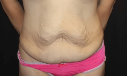 Tummy Tuck Before & After Patient #28581