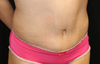 Tummy Tuck Before & After Patient #28581