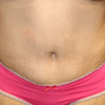 Tummy Tuck Before & After Patient #28581