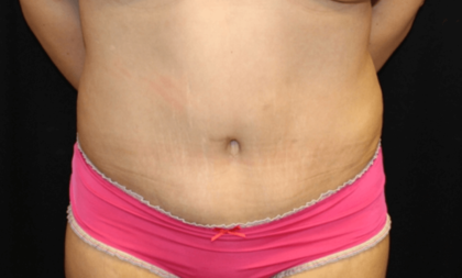 Tummy Tuck Before & After Patient #28581