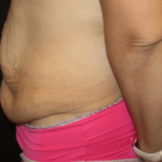 Tummy Tuck Before & After Patient #28581