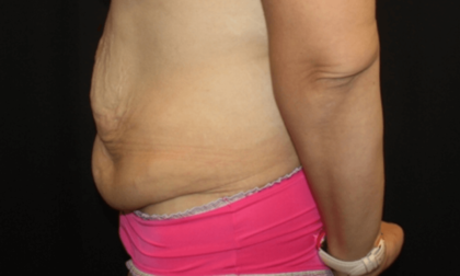 Tummy Tuck Before & After Patient #28581