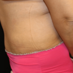 Tummy Tuck Before & After Patient #28581