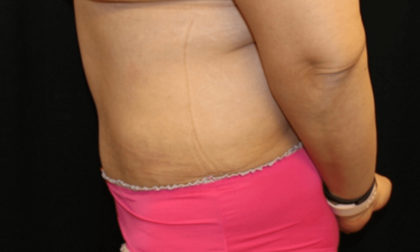 Tummy Tuck Before & After Patient #28581