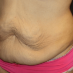 Tummy Tuck Before & After Patient #28581