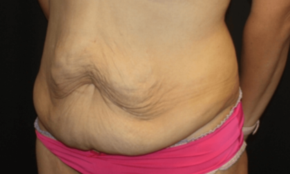 Tummy Tuck Before & After Patient #28581