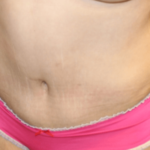 Tummy Tuck Before & After Patient #28581