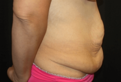 Tummy Tuck Before & After Patient #28581