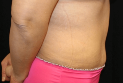 Tummy Tuck Before & After Patient #28581