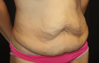 Tummy Tuck Before & After Patient #28581