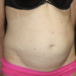 Tummy Tuck Before & After Patient #28691