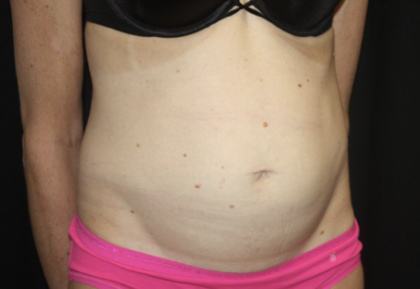 Tummy Tuck Before & After Patient #28691