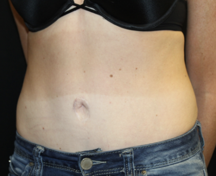 Tummy Tuck Before & After Patient #28691