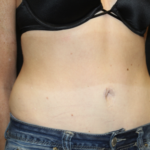 Tummy Tuck Before & After Patient #28691