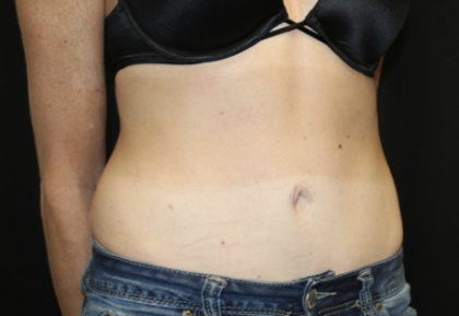 Tummy Tuck Before & After Patient #28691