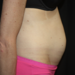 Tummy Tuck Before & After Patient #28691