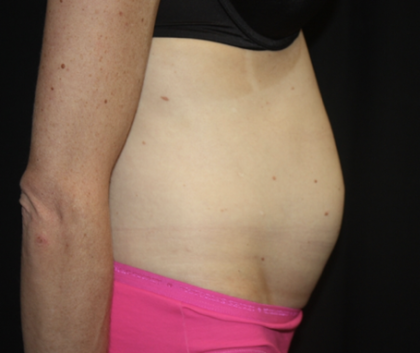 Tummy Tuck Before & After Patient #28691