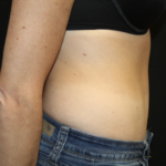 Tummy Tuck Before & After Patient #28691