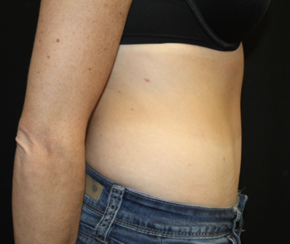 Tummy Tuck Before & After Patient #28691