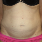 Tummy Tuck Before & After Patient #28691