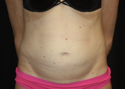 Tummy Tuck Before & After Patient #28691