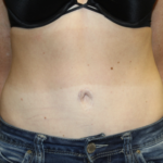 Tummy Tuck Before & After Patient #28691