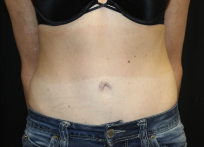 Tummy Tuck Before & After Patient #28691